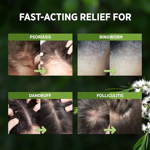 RoyceDerm Tea Tree Scalp Relief Spray for Dry Itchy Scalp Hydration & Balance