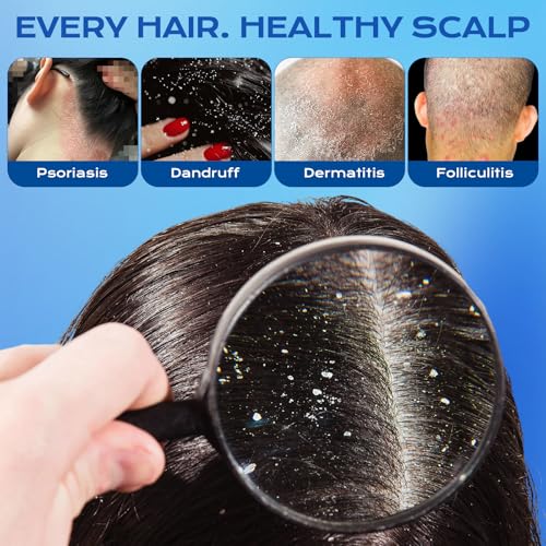 FYZMTL 1% Ketoconazole Anti-Dandruff Shampoo 6.75 Fl Oz Scalp Treatment for Itchy Flakes