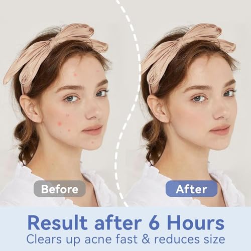 Invisible Pimple Patches for Face - £¨12mm | 72 Count | 6 Sheets£© - Ultra-Thin Hydrocolloid Blemish Cover, Discreet Zit Stickers for Day & Night, Face Patches for Teens and Adults
