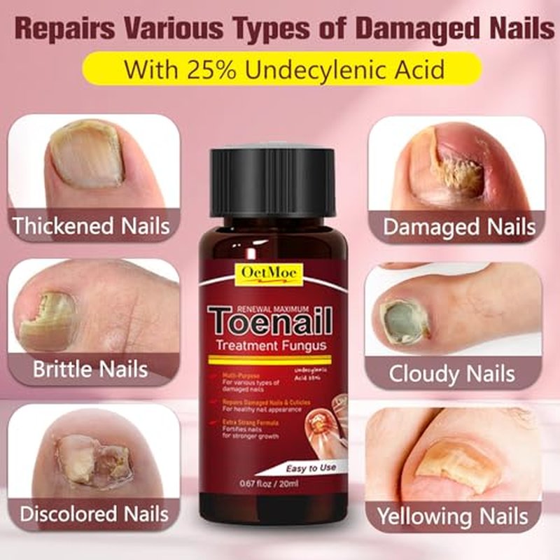 Extra Strength Toenail Fungus Treatment with 25% Undecylenic Acid