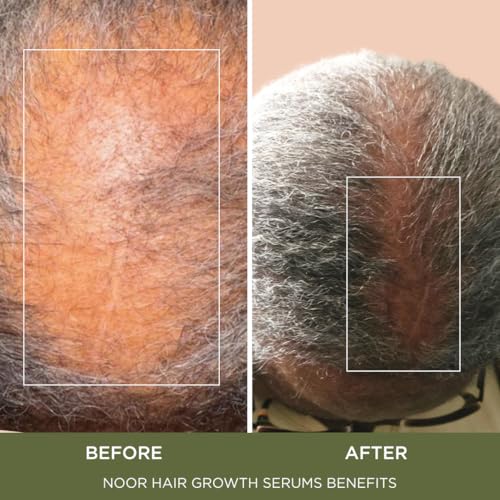 NOOR HAIR Growth Serum for Frizzy & Damaged Hair - Blocks Hair Loss