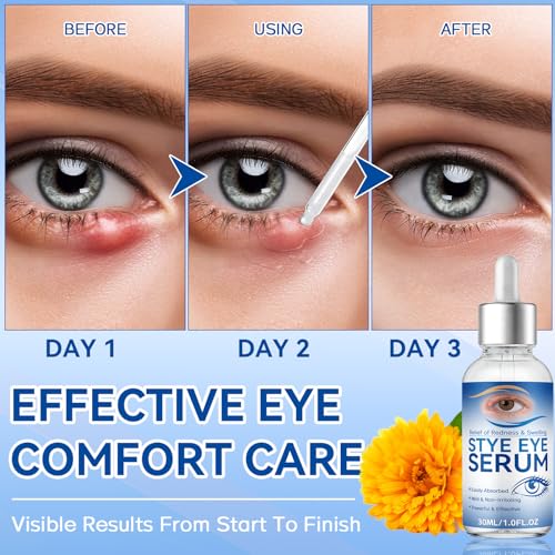 Stye Eye Treatment Serum 30ml - Natural Relief for Styes & Blepharitis