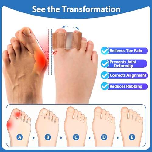 NIXWAV 2 Pack Bunion Toe Separators L, 3-Point Gel Spacers with Dual Loops