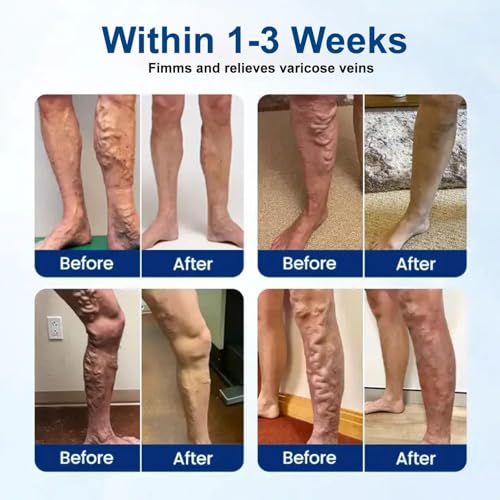 Varicose Veins Treatment Patches for Legs - 4 Cuttable Pcs
