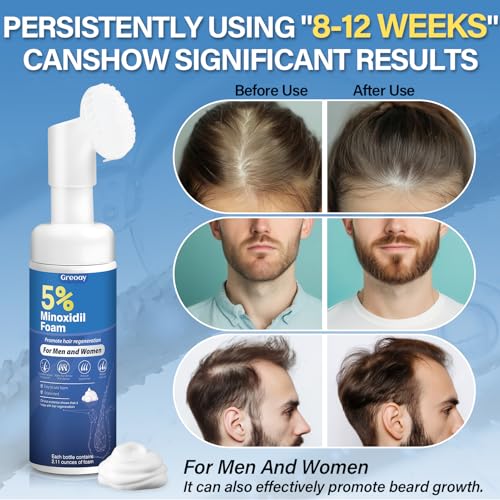 5% Minoxidil Hair Growth Foam for Men & Women