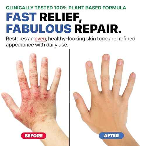 Eczema Cream for Adults & Kids ? Hypoallergenic Barrier Repair Moisturizer, Clinically Proven (3 Studies), Fragrance-Free, Dermatologist Tested, Face & Body Hydration, NEA Accepted, USA Made