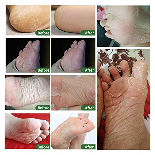 ALIVER Exfoliating Foot Peeling Mask 5-Pack - Lavender Foot Peel Socks