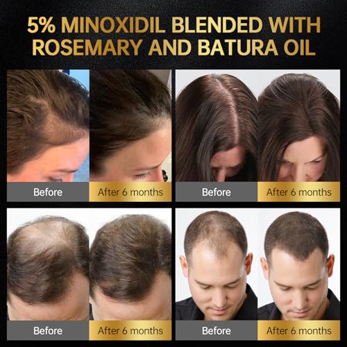 Minoxidil 5% Hair Regrowth Serum for Men & Women, 60ml