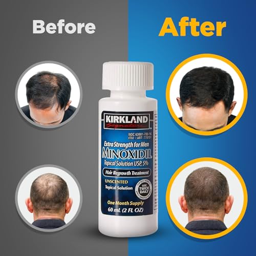 Kirkland Signature 5% Minoxidil Hair Regrowth for Men - 1 Month Supply