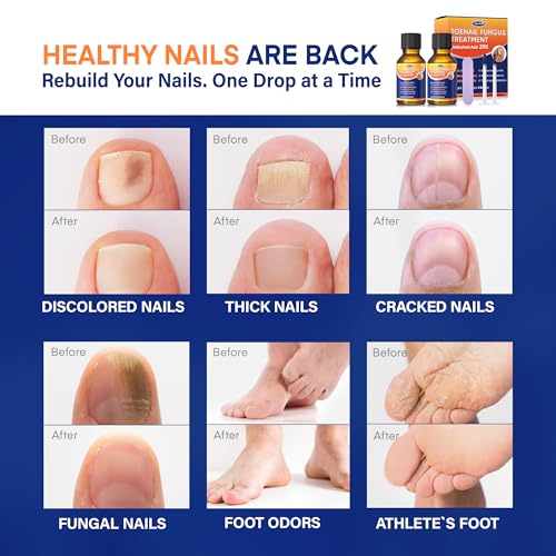Toenail Fungus Treatment 25% Undecylenic Acid Extra Strength