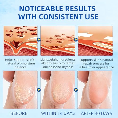 60% Urea Foot Cream Stick with 2% Salicylic Acid for Dry Cracked Heels 1.41 oz