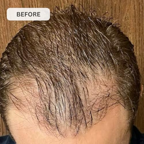 Kiierr 272 MD Laser Cap | FDA-Cleared Hair Loss Treatment