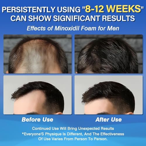 Minoxidil 5% Foam for Men Hair Growth & Regrowth