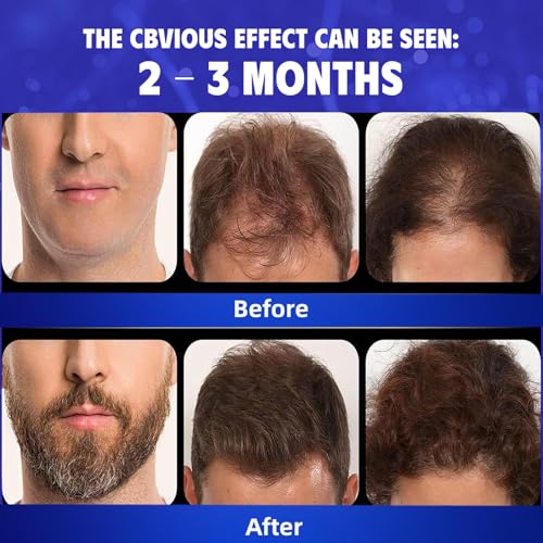 5% Minoxidil Hair Regrowth Serum for Men & Women - 4-Pack