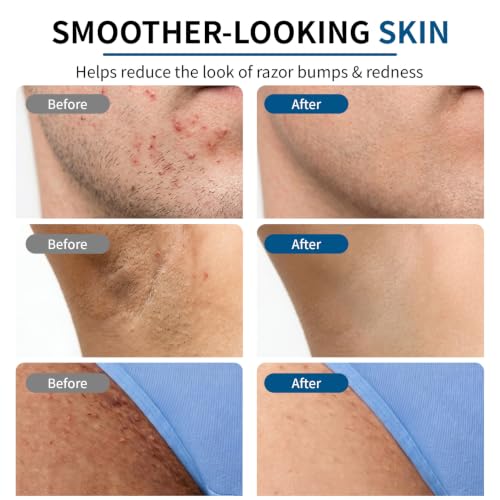 Razor Bumps Ingrown Hair Treatment: 3.38fl.oz Smoothing Solution for