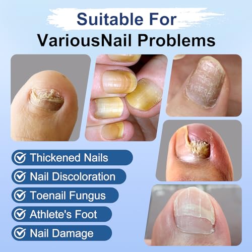 Toenail Fungus Treatment Pen 25% Undecylenic Acid - 6 Pack