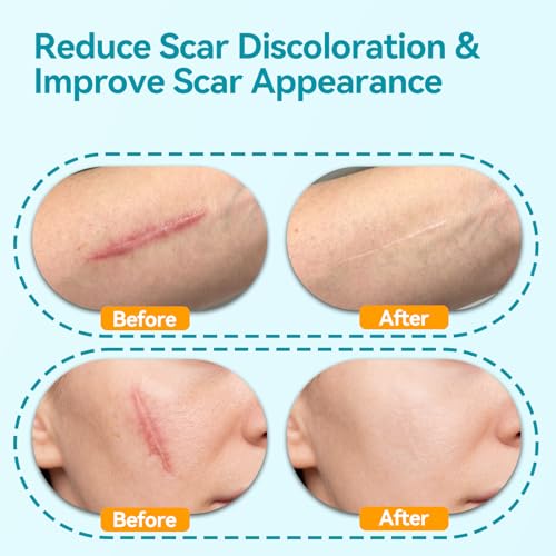 Dimora UPF50+ Silicone Scar Sheets with UV Protection Reusable Sheets to Soften, Flatten Fade Scars, Reduce Redness for Surgical, C-Section, Burn, Keloid, and Hypertrophic Scars (1.6¡±x78.7 Roll)
