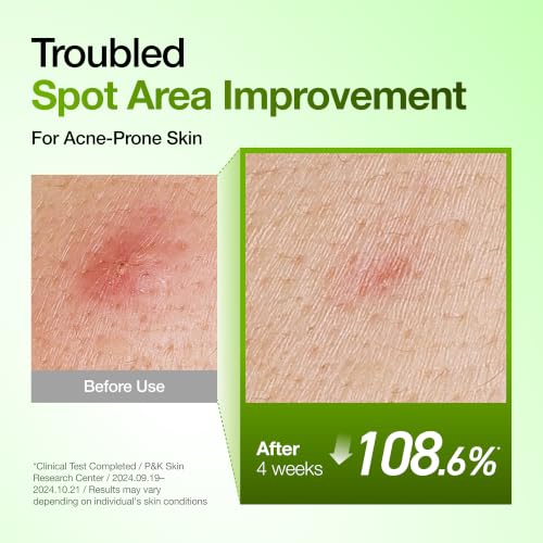 Anua Azelaic Acid 10% Serum with Hyaluronic Acid