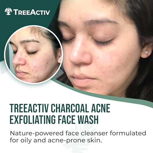 TreeActiv Charcoal Acne Exfoliating Face Wash | Hydrating Sulfur Cleanser for Pimple, Zit, Whitehead, & Blackhead | Facial Treatment for Hormonal & Cystic Acne | Teen & Adult Milia Remover | 425+ Uses