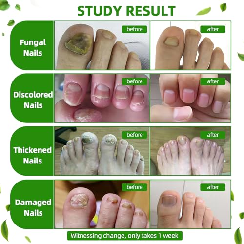 NoxyRal Extra Strength Toenail Fungus Treatment Brush-On with Botanical Oils, 1 fl oz