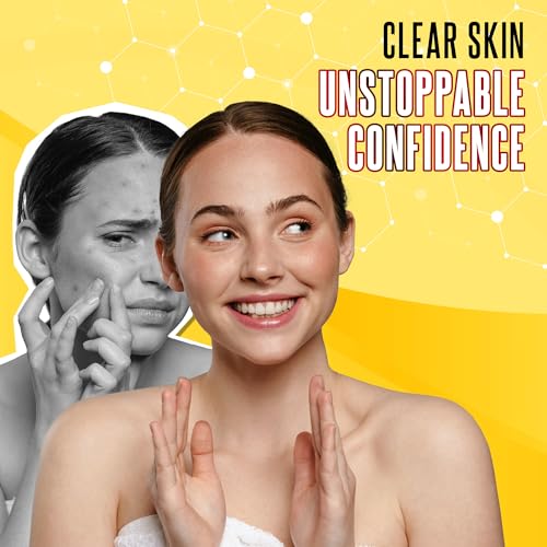 Biosulfur Grisi Acne Treatment Soap: Deep Cleansing, Acne-Fighting, Reduces Inflammation, Prevents Breakouts, Blackheads, Excess Oil, Sulfur Soap Bar, 4.4 oz, 3-Pack