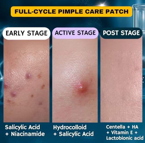 Hydrocolloid Acne Patches with Salicylic Acid - 108 Pimple Stickers