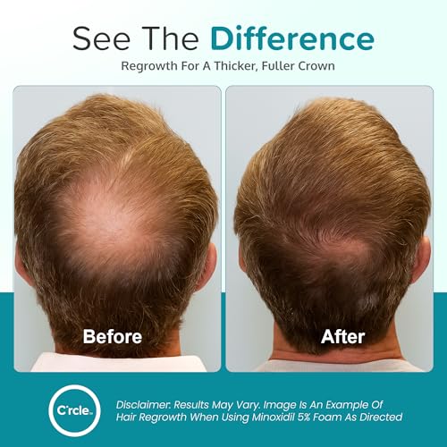 Minoxidil 5% Foam for Men Hair Regrowth - 3 Month Supply