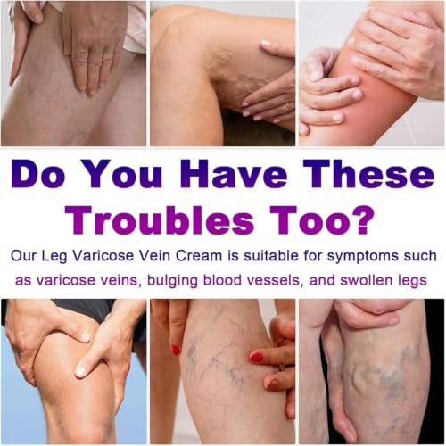 Varicose Veins Cream for Legs - Spider Vein Treatment & Relief