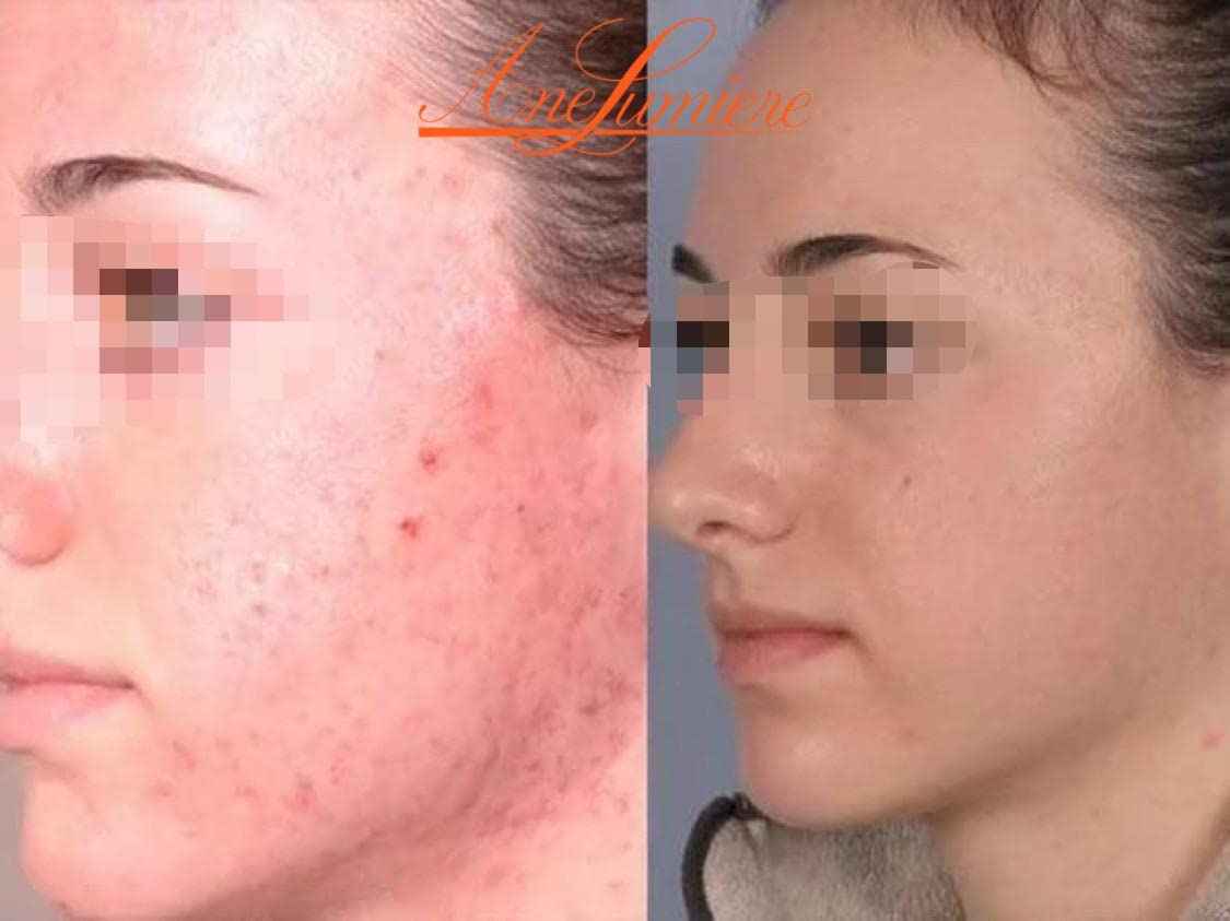 Ane Lumiere Anti Acne Chemical Peel Kit Acid Peeling For Face 1.69oz BHA Acne Treatment for face skin peel