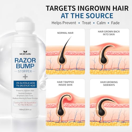 Razor Bumps Ingrown Hair Treatment: 3.38fl.oz Smoothing Solution for