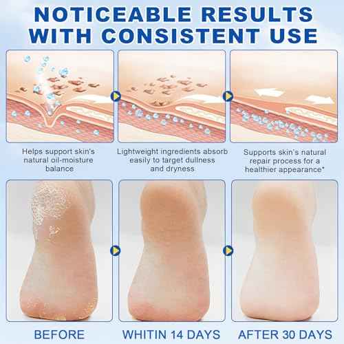 Urea Cream 60 Percent for Feet, 2% Salicylic Acid Urea Foot Cream for Cracked Heels and Dry Skin, Deep Moisturizing, Cracked Heel Repair Cream, Repairing Creams for Heels, Knees, Elbows & Hands (2)