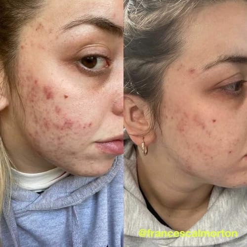 Carbon Theory | Charcoal, Tea Tree Oil & Vitamin E Overnight Detox Facial Serum | 30ml