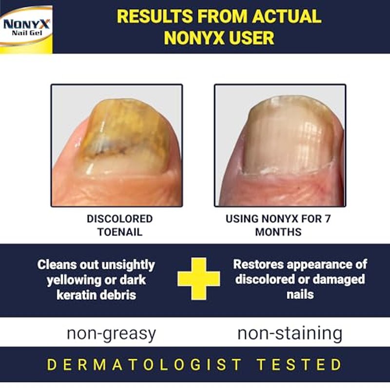 NONYX Fungal Nail Clarifying Gel – Clinically Proven for Thick, Yellow, Brittle Nails
