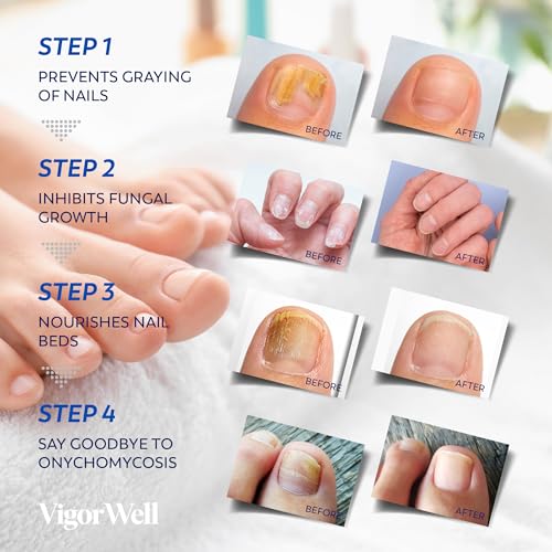 VigorWell Toenail Fungus Treatment Patches - 32 Hydrogel