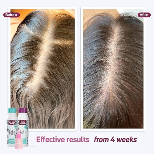 D'Luchi Hair Growth Treatment Kit - 3-Piece Set with Red Onion Shampoo
