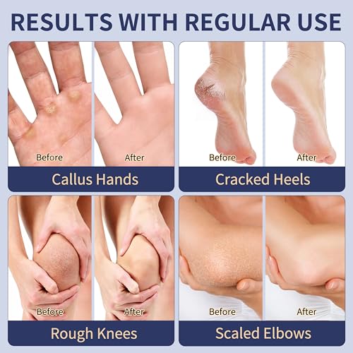 Veakoo 40% Urea Foot Cream with 2% Salicylic Acid for Dry Cracked Heels