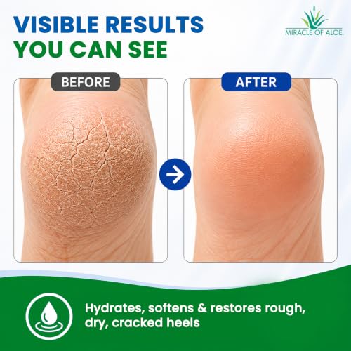 Miracle of Aloe Heel Balm Stick with Silicone Gel Socks for Dry Feet