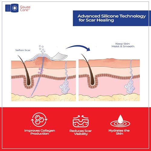 GauzeCare Silicone Scar Tape ? 1.6¡±x60¡± Roll ? Medical-Grade, Reusable, Professional Silicone Scar Tape for surgical scars, C-Section, Burns, Keloid, and Acne Scars