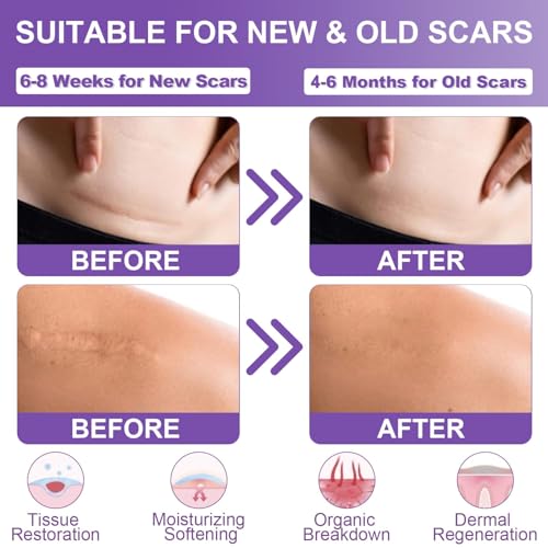 Silicone Scar Sheets, Medical Grade Silicone Scar Tape (1.6" x 120"), Professional Scar Removal Treatment, Reusable, for Healing Keloids, Surgeries Scars, C-sections, and Burns