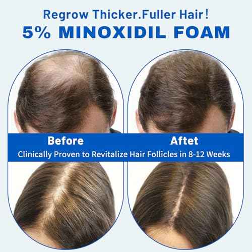 5% Minoxidil Hair Growth Foam for Men & Women ? 2 Pack (60ml Each) | Extra Strength Hair Regrowth Treatment with Biotin | Supports Thicker, Fuller-Looking Hair