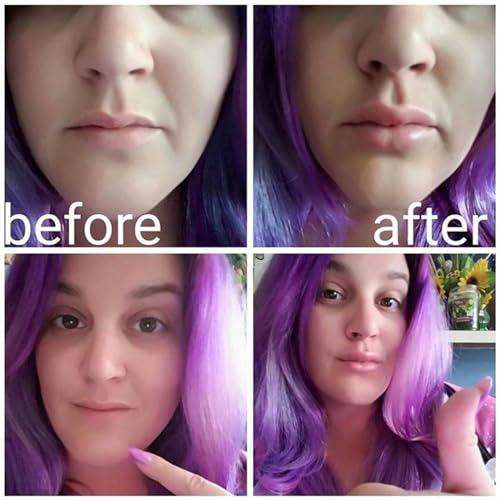 PASSI Fish Shape Lip Plumper Device - Fuller Lips Enhancer