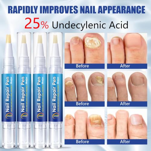 Extra Strength Toenail Fungus Treatment Pen with Tea Tree Oil
