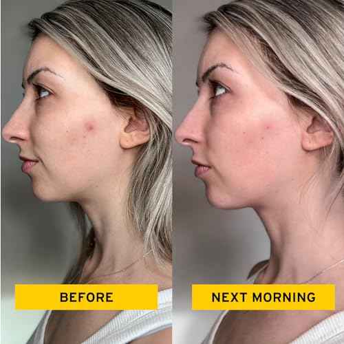 No Bad Stuff - All Day Healing Acne Patches & Intensive Overnight Pimple Patches Duo - Day & Night Acne Patches for Blemishes with Soothing Calamine, Minimizes Scars (144 ct)