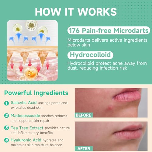 72-Count Microdart Acne Patches, Hydrocolloid Pimple Patches with Salicylic Acid & Madecossoside, Microdart Zit Patches for Deep Blemishes & Early Stage Acne (Patented)