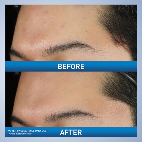 CeraVe Acne Foaming Cream Wash with 10% Benzoyl Peroxide
