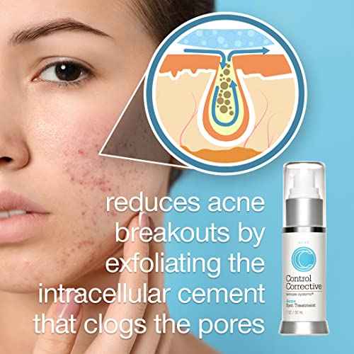 CONTROL CORRECTIVE Acne Spot Treatment Gel ? 2% Salicylic Acid + Glycolic Acid Formula for Breakouts & Blemishes ? With Witch Hazel, Aloe & Panthenol ? 1 oz Clear Skin Serum