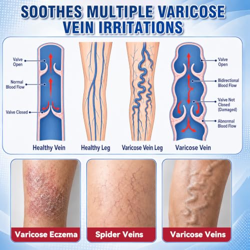 Bellemora Varicose Veins Cream – Relief for Legs & Circulation