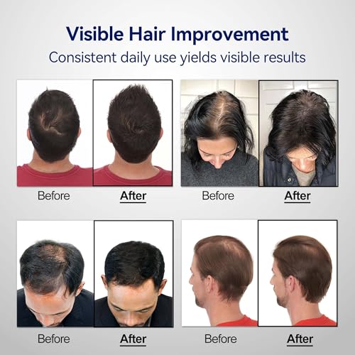 Wireless Red Light Therapy Cap for Hair Growth - FDA Cleared