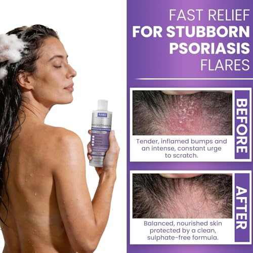 Medicated Anti Dandruff Shampoo for Men & Women | Scalp Psoriasis Relief