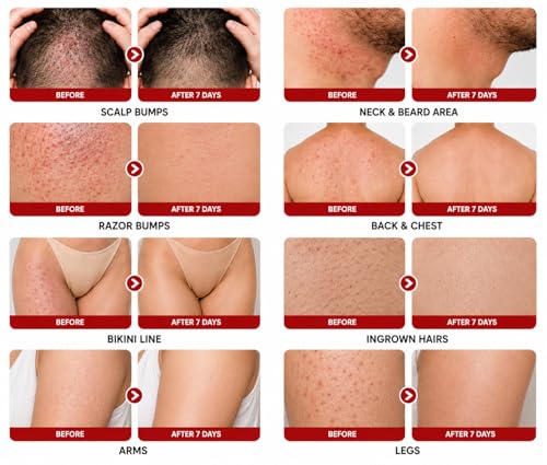 5% Benzoyl Peroxide Bump Cream for Scalp, Back & Body